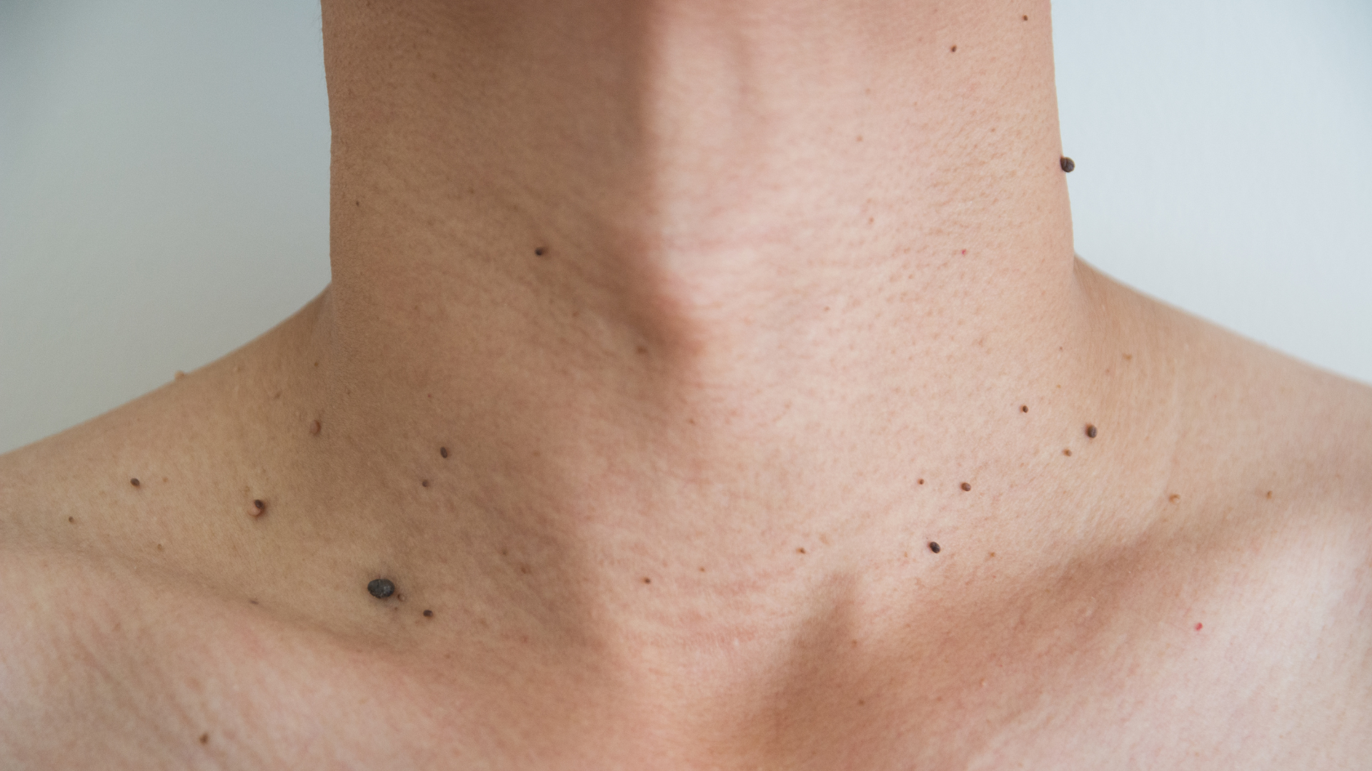 Skin Tags: What They're Actually Telling You About Your Health